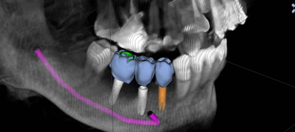 痛みの少ないデジタルインプラント治療
